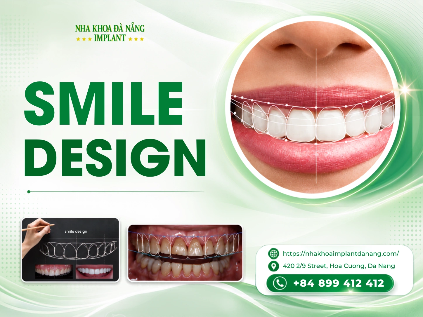 Smile design