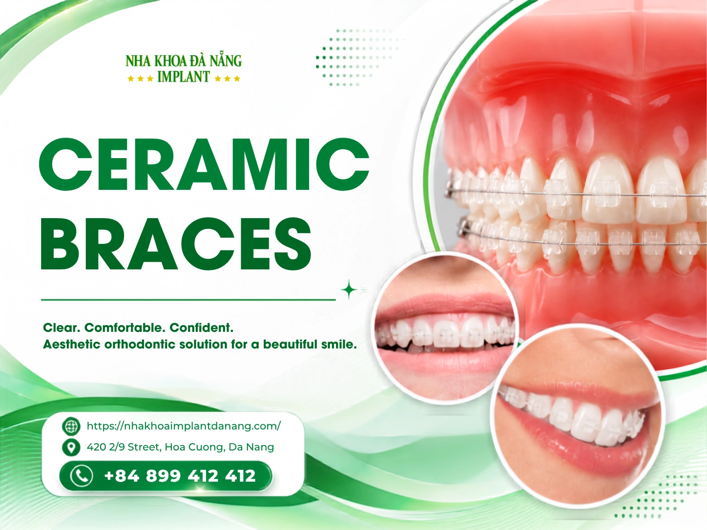Ceramic Braces