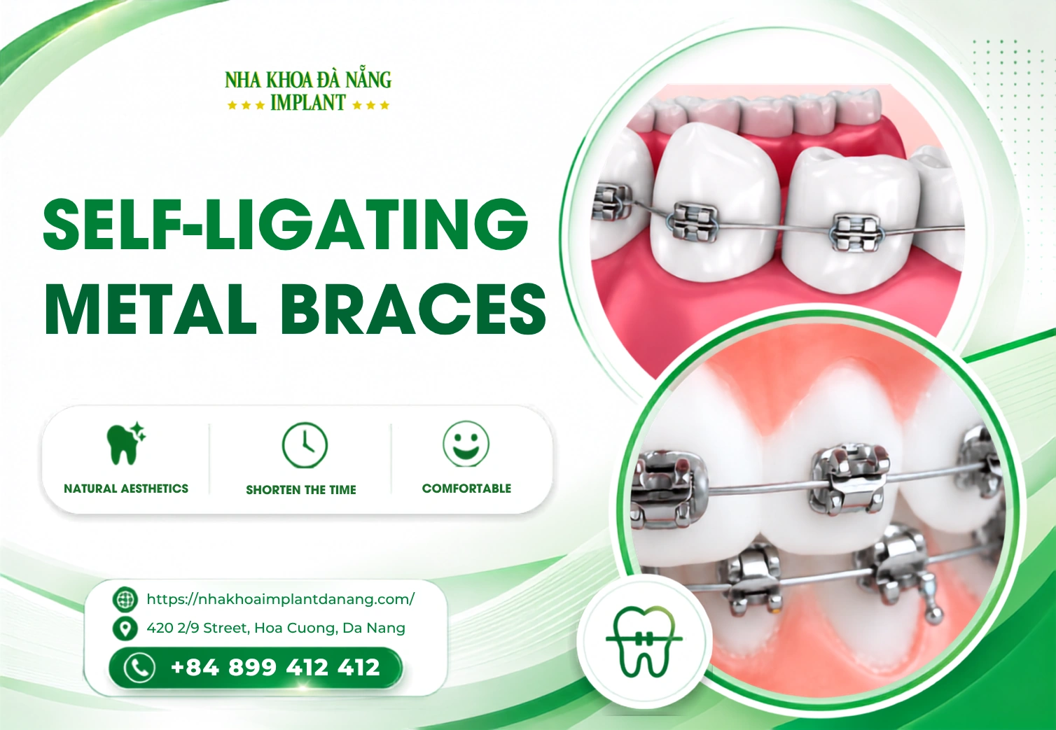 Self-ligating Medal Braces