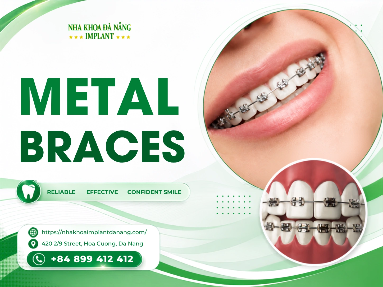 Traditional Metal Braces