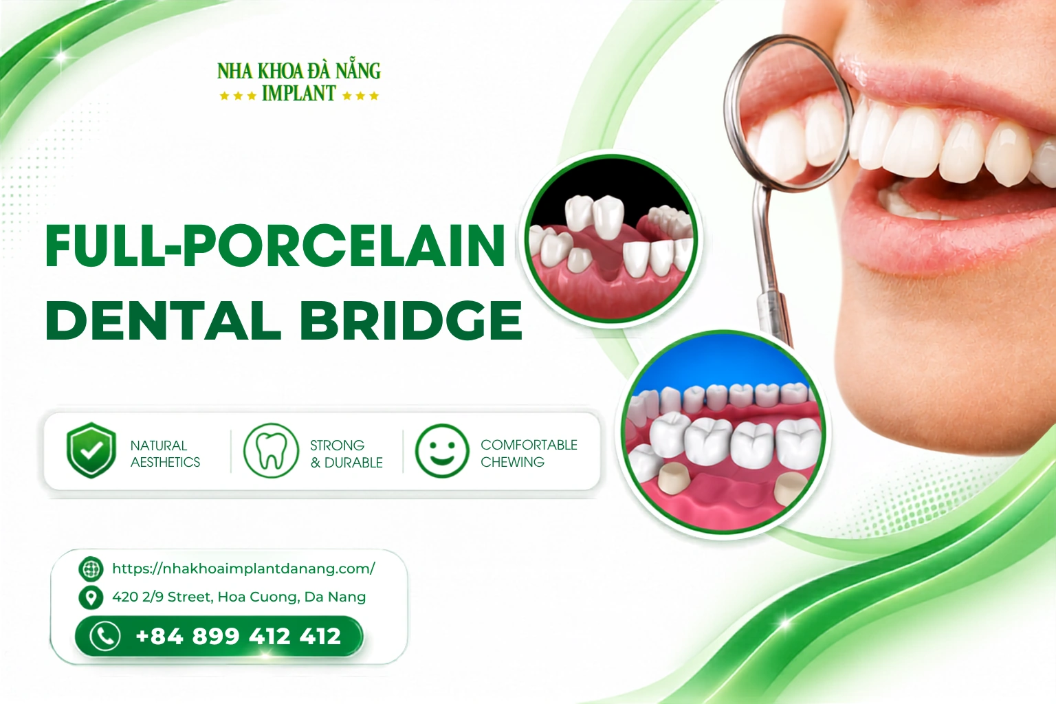 Full-porcelain Dental Bridge