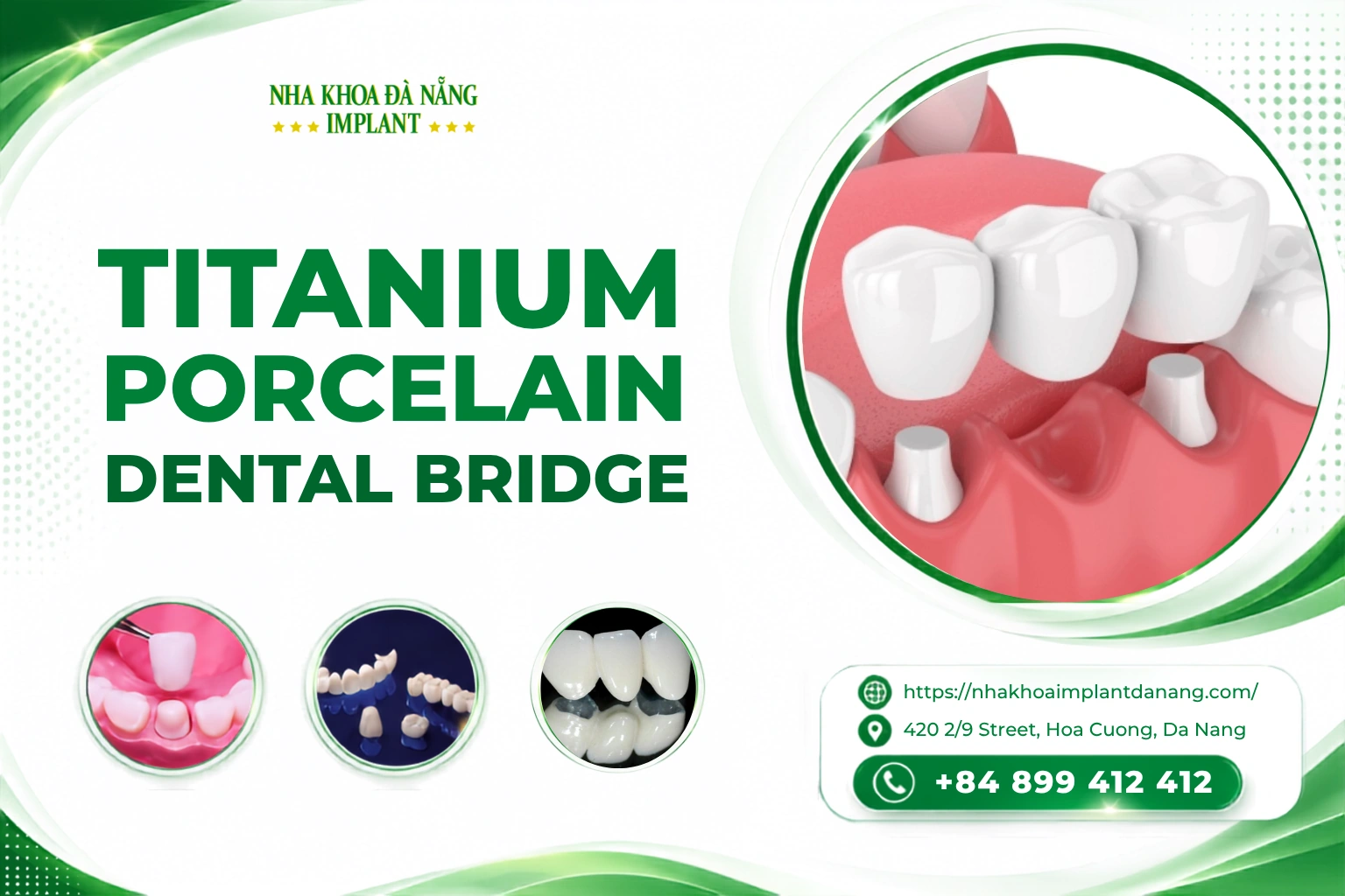 Titanium Porcelain Dental Bridge