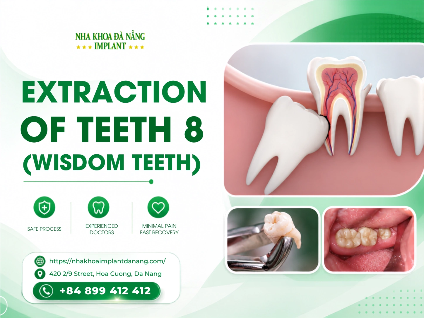 Extraction of teeth 8 (wisdom teeth)