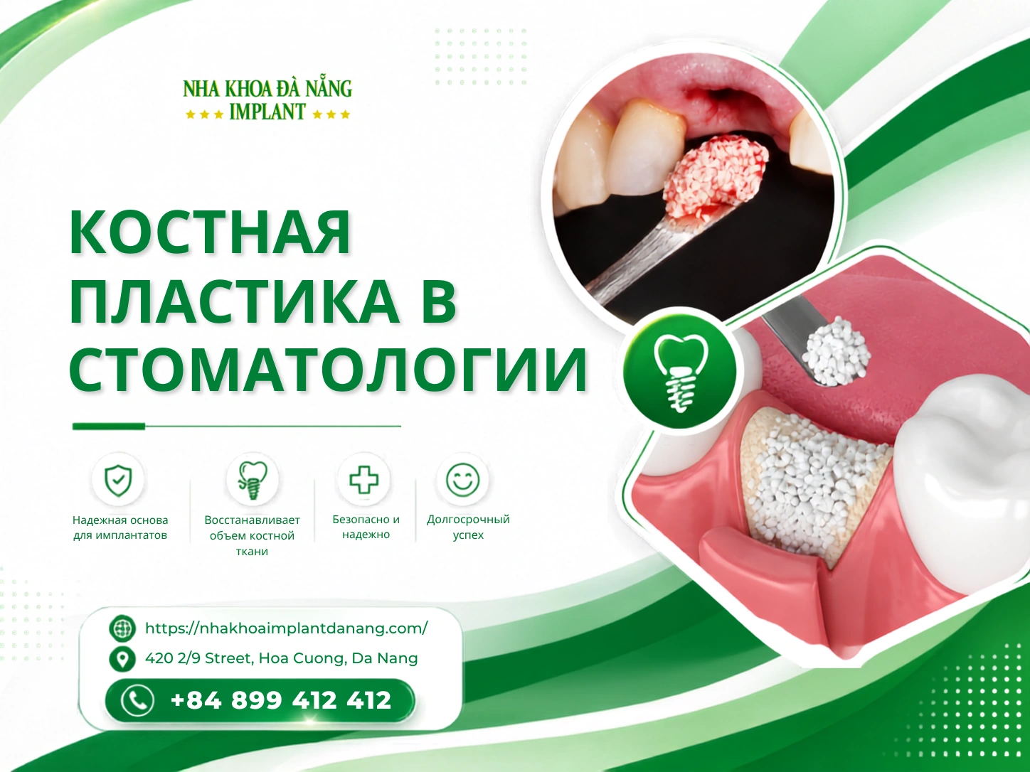 Костная пластика в стоматологии