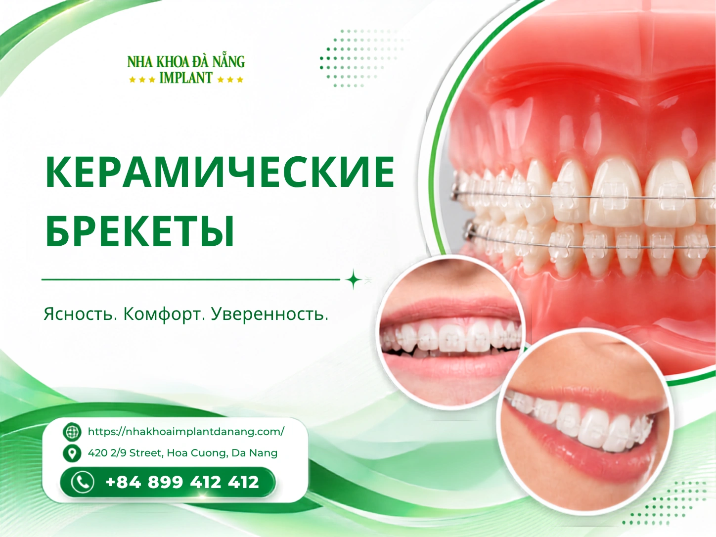 Керамические брекеты