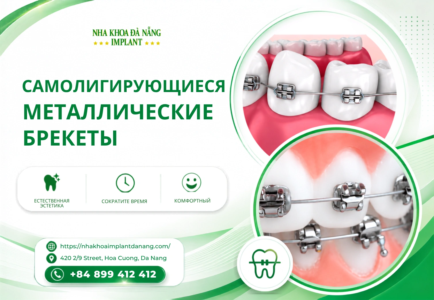 Самолигирующиеся металлические брекеты