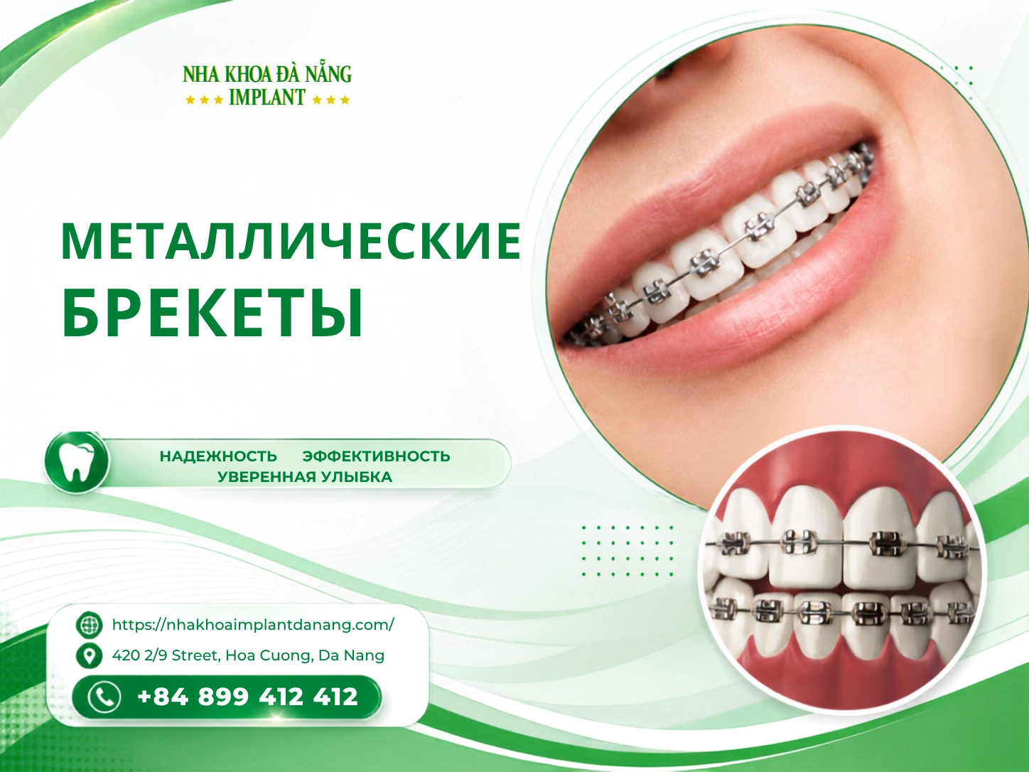 Металлические брекеты