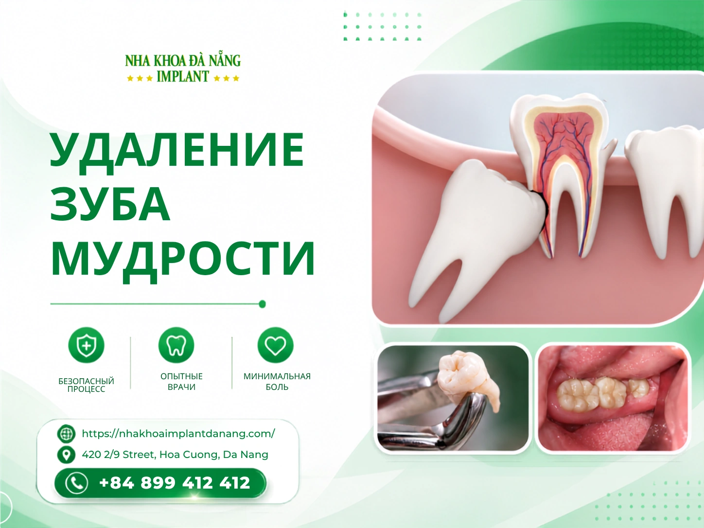 Удаление зуба мудрости