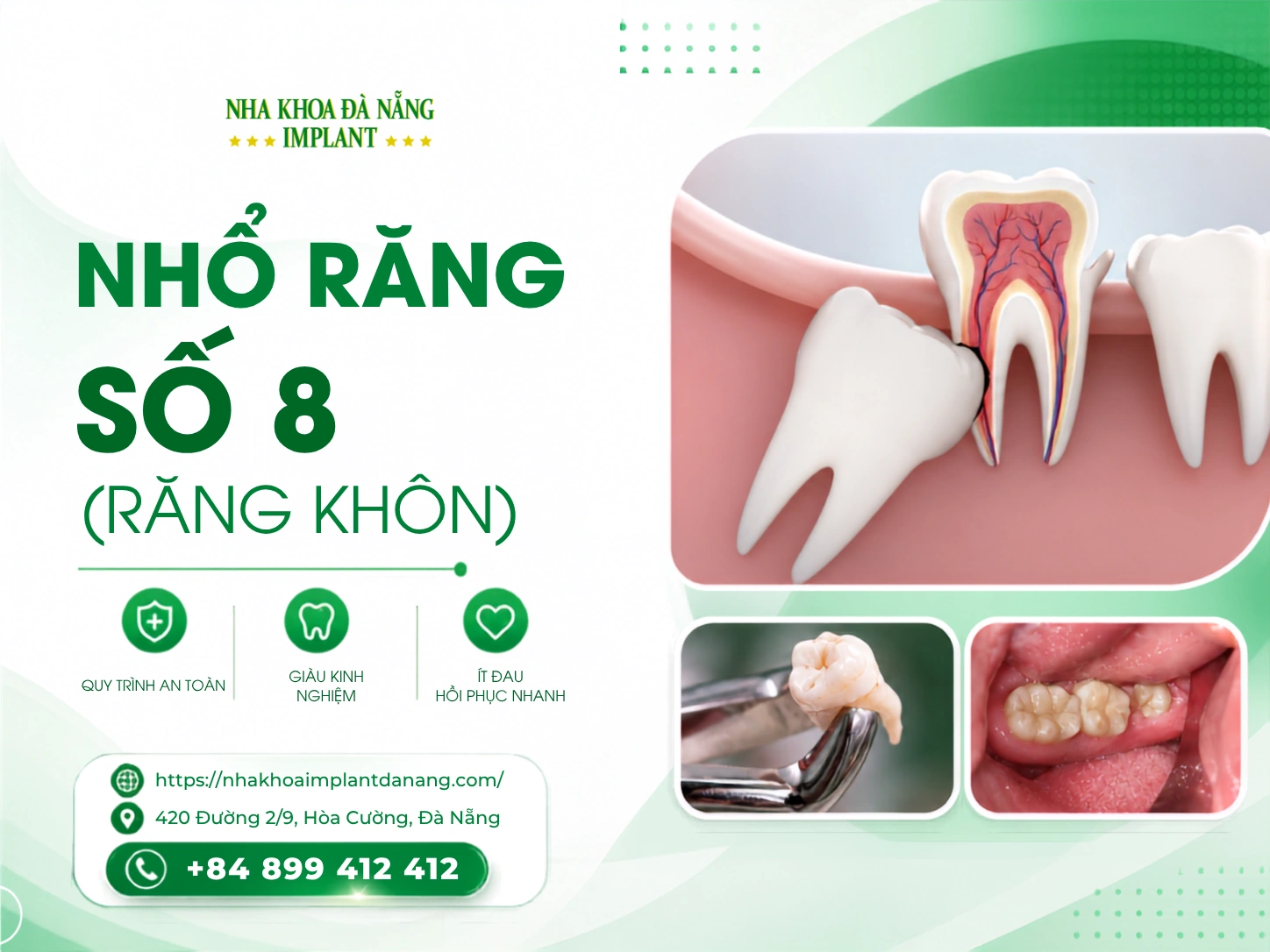 Nhổ răng số 8 (răng khôn)