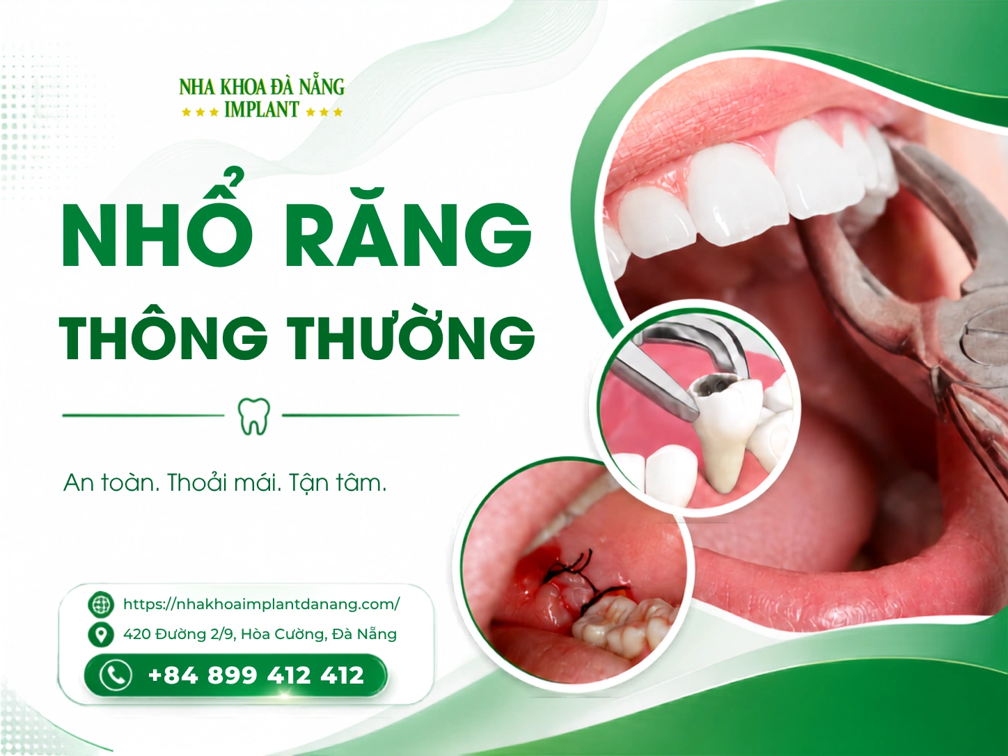 Nhổ răng thông thường