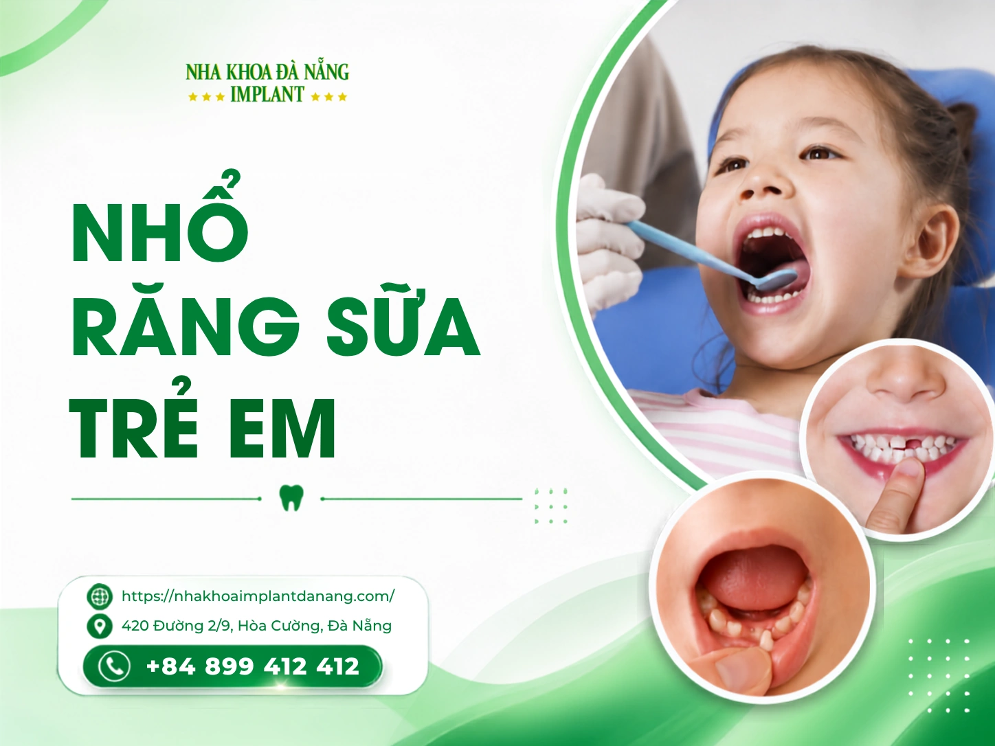 Nhổ răng sữa trẻ em