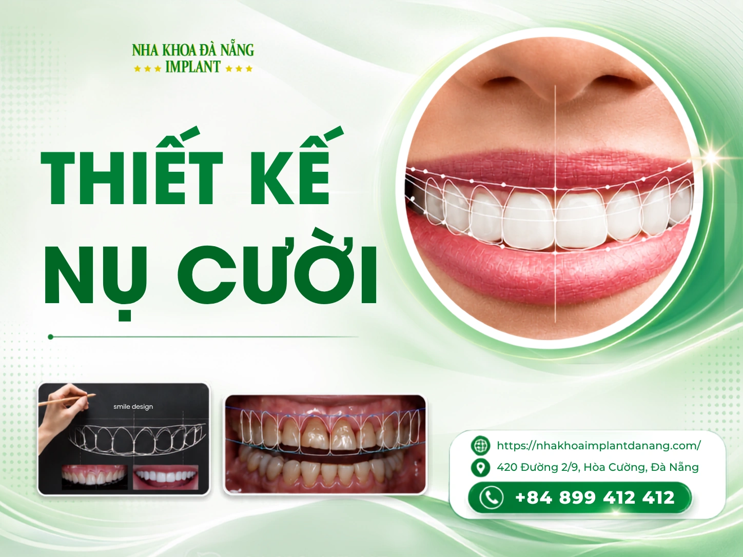 Thiết kế nụ cười