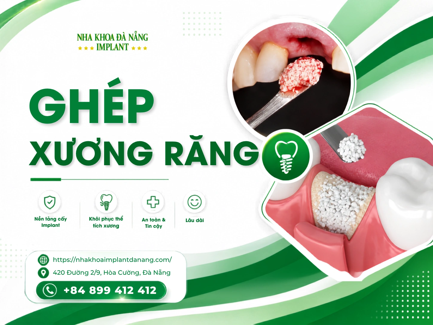 Ghép xương răng