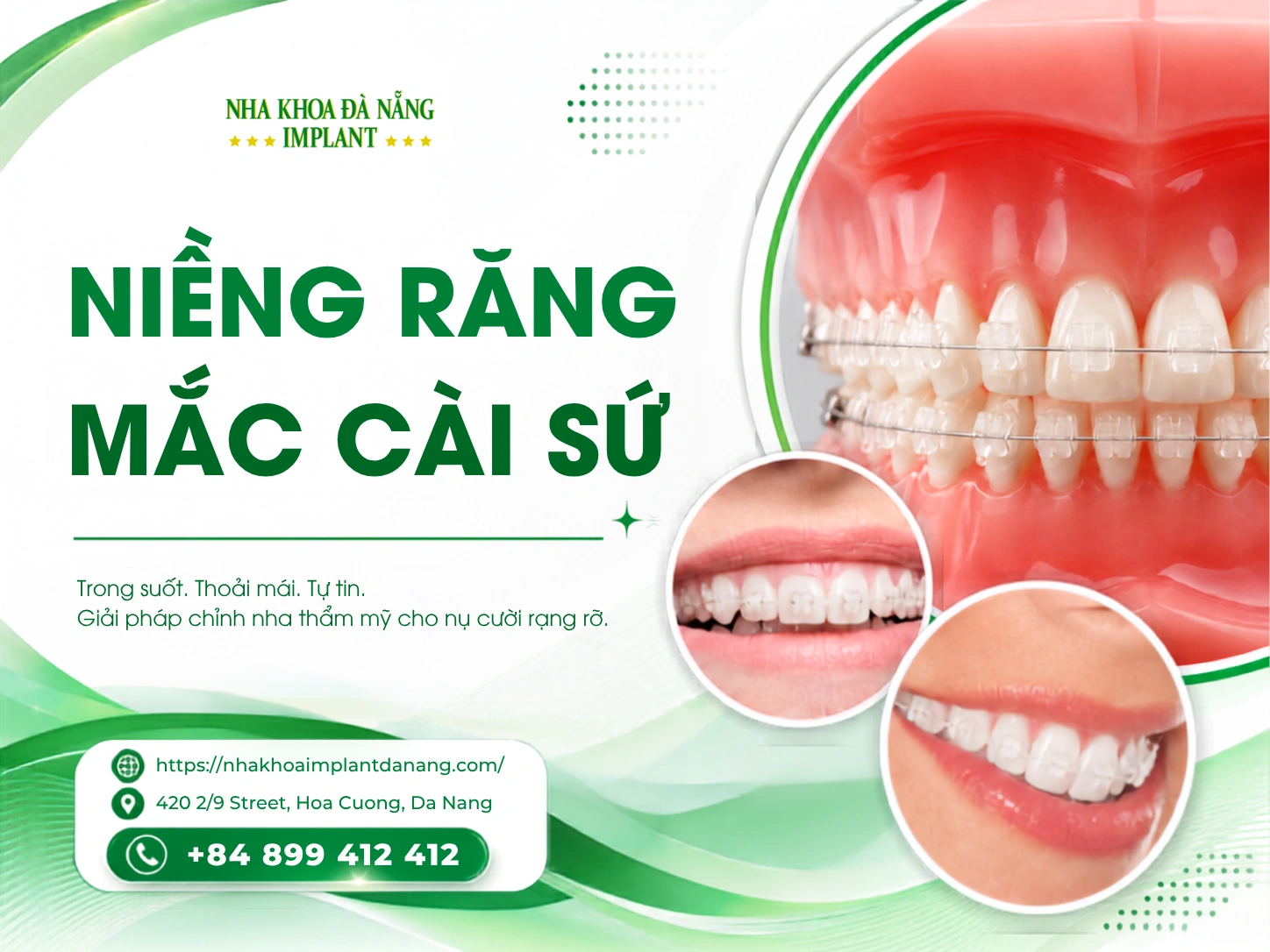 Niềng răng mắc cài sứ