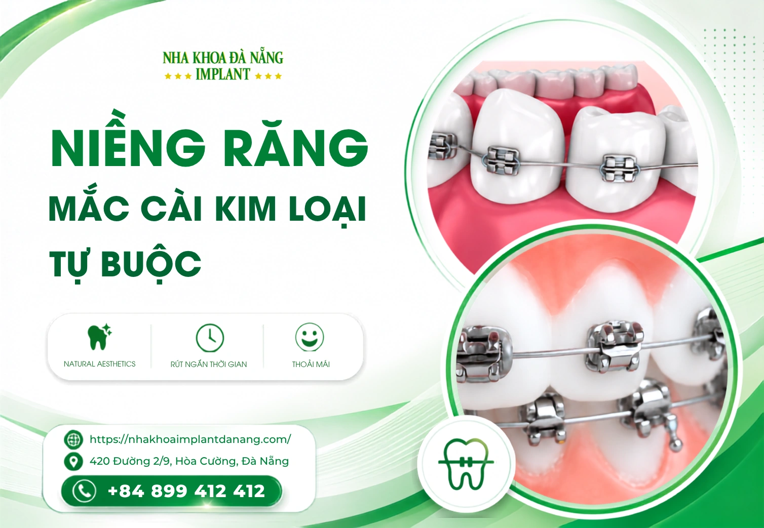 Niềng răng mắc cài kim loại tự buộc