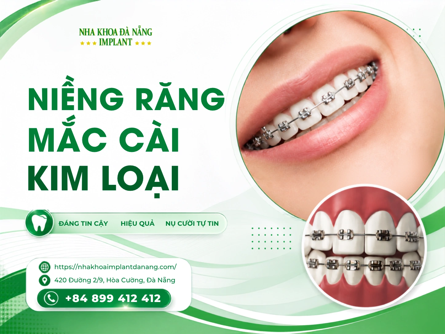 Niềng răng mắc cài kim loại