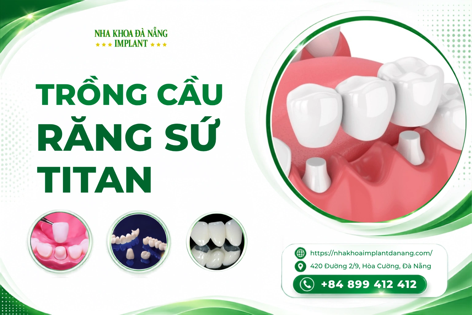 Trồng cầu răng sứ – titan