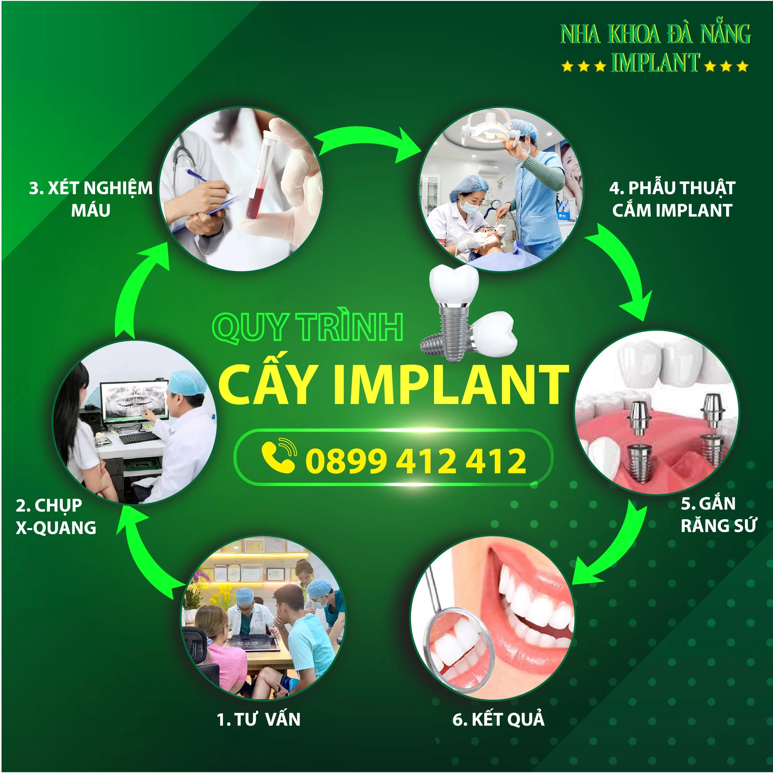 Giải pháp trồng răng Implant an toàn tại Đà Nẵng với "GPS nha khoa" X-Guide – Giá mới nhất 2025 11 Quy trình trồng răng tại Nha khoa Đà Nẵng Implant