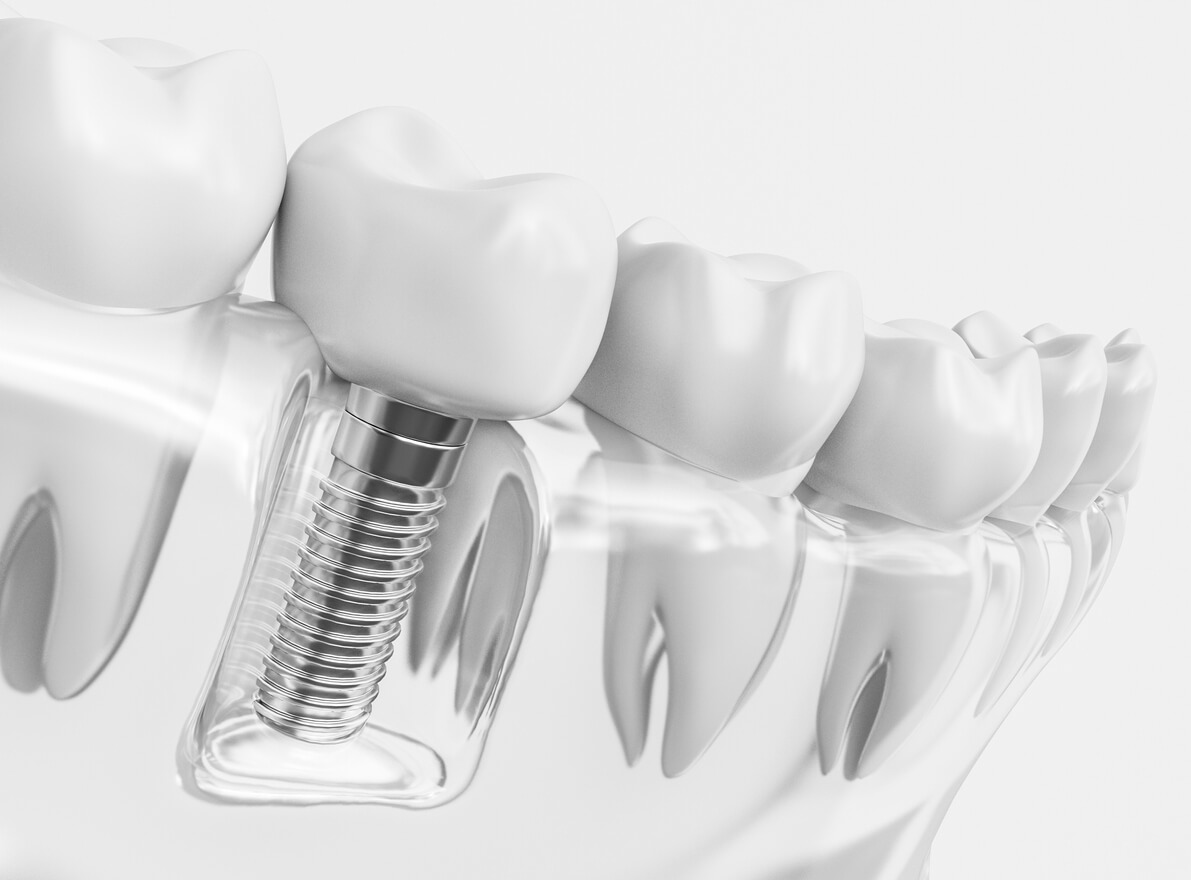 Trồng răng sứ titan và những điều bạn nên biết
