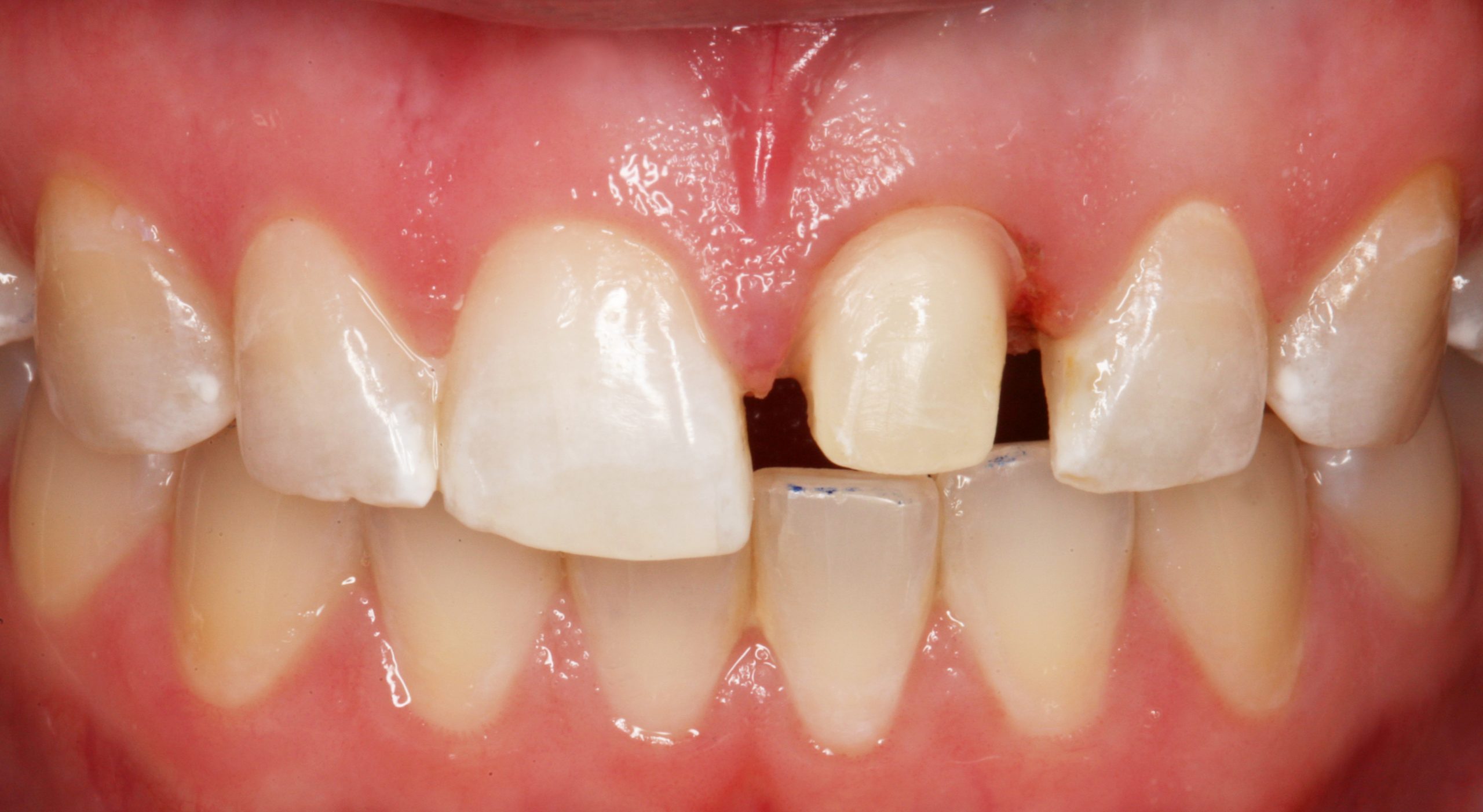 Quy trình trồng răng