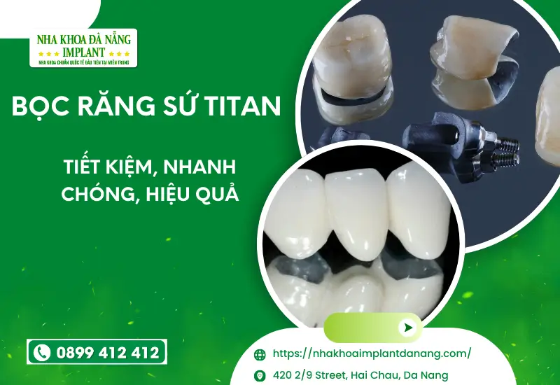 Bọc răng sứ Titan - Tiết kiệm, Nhanh chóng, Hiệu quả