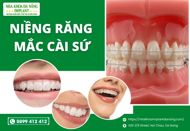 Niềng răng mắc cài sứ
