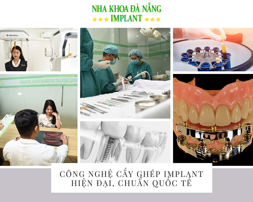Da Nang Implant Dentistry is a leading dental clinic specializing in dental implants