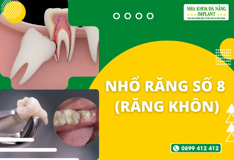 Nhổ răng số 8 (răng khôn)
