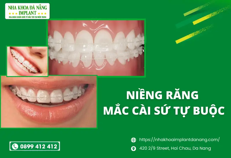 Niềng răng mắc cài sứ tự buộc