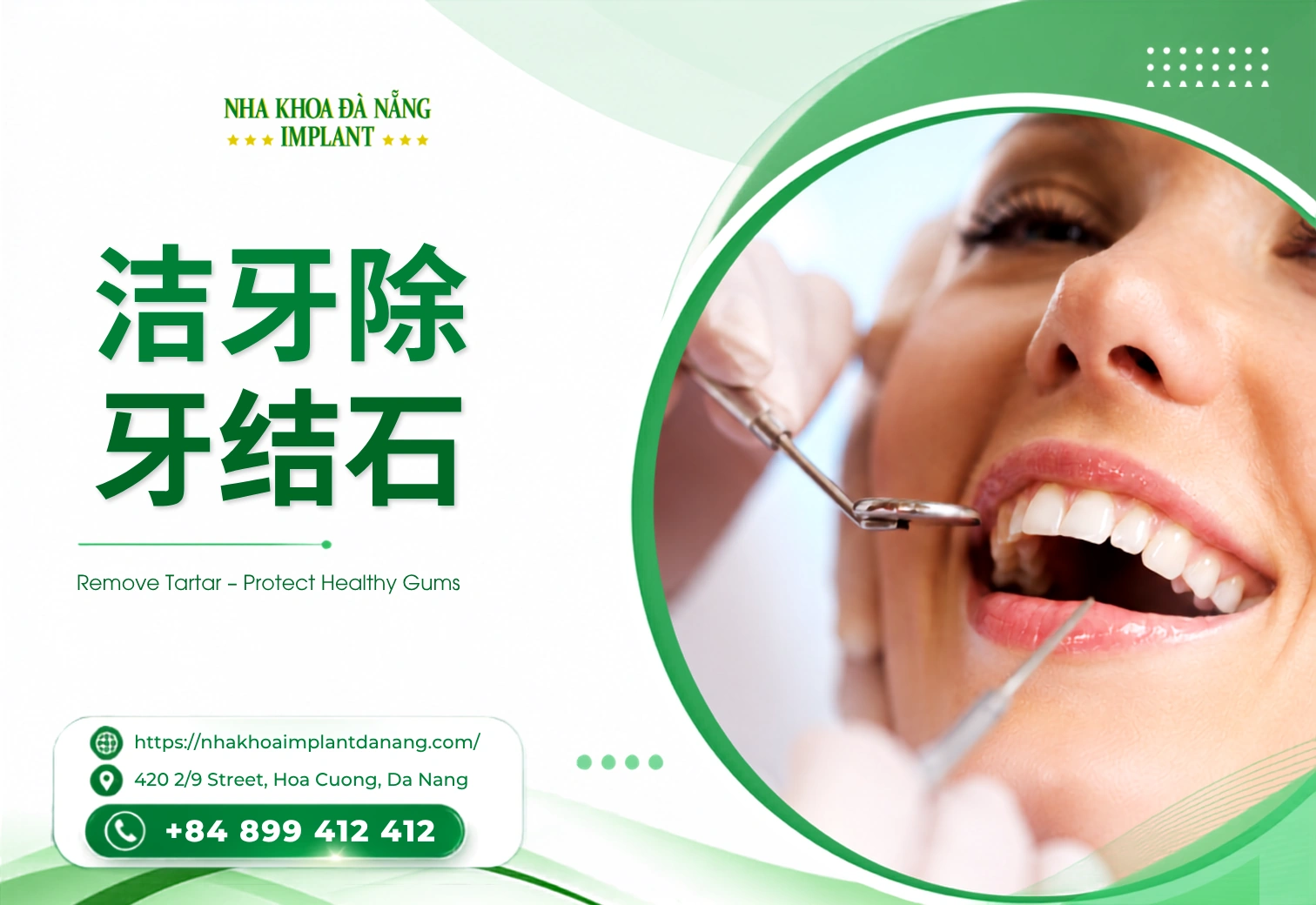 牙结石清除（洁治）