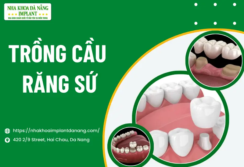 Trồng cầu răng sứ