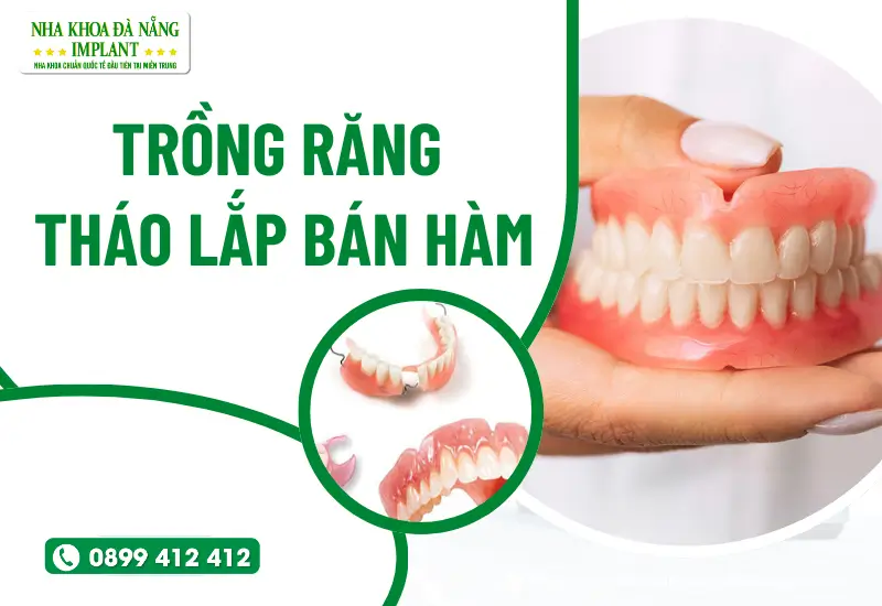 Trồng răng tháo lắp bán hàm