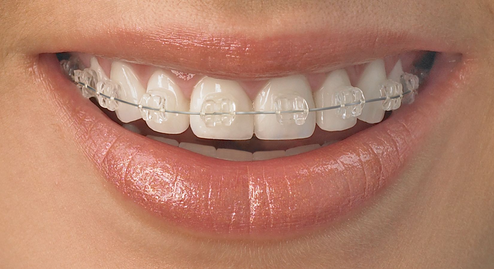 Ceramic braces use a system of arch wires and porcelain tooth-colored brackets for the purpose of aligning teeth and adjusting bite.