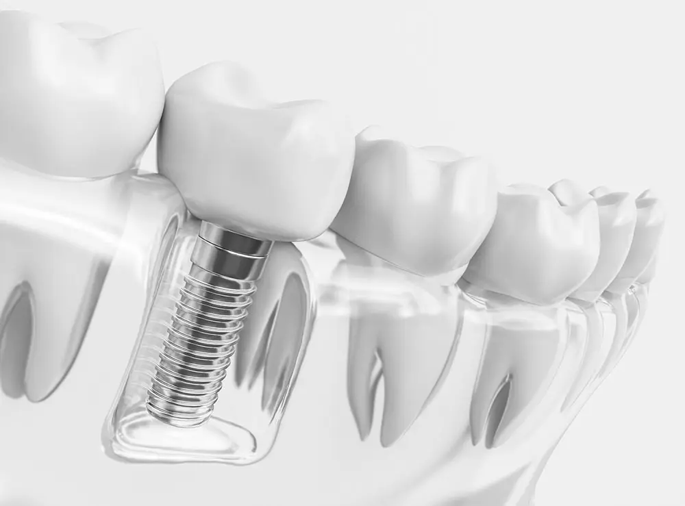 Sau khi trồng răng implant nên ăn gì kiêng gì?
