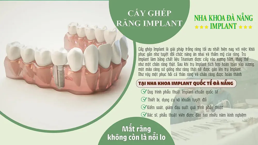 Cấy ghép răng Implant là phương pháp phục hình răng đã mất bằng cách cấy 1 trụ titan vào xương hàm