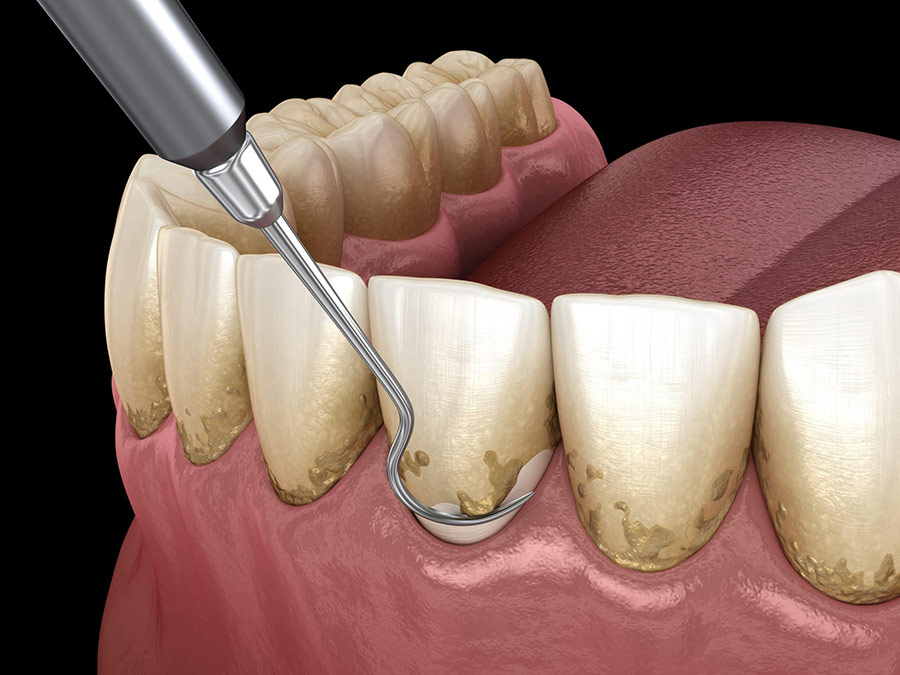 Bước 1: Thăm khám đánh giá tình trạng vôi răng và tổ chức quanh răng hiện tại