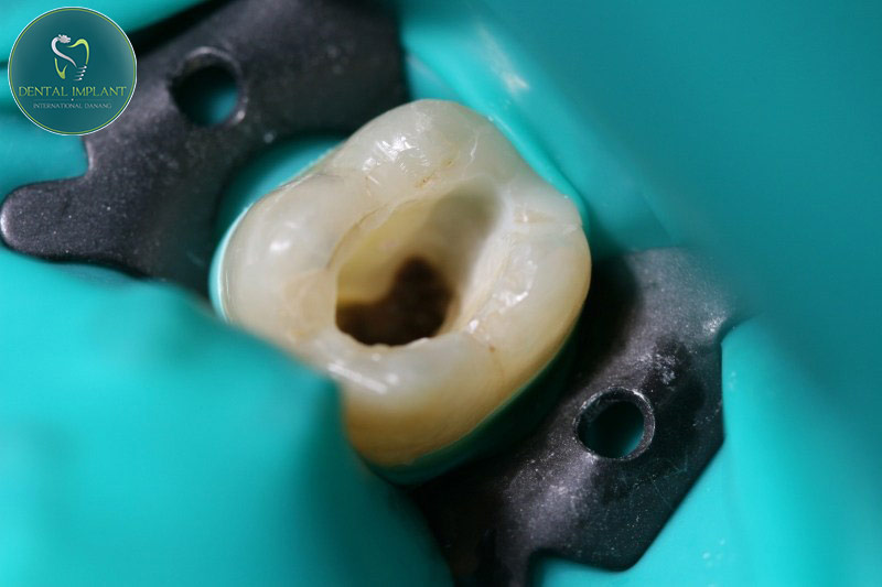 Placing rubber dam plays an important role in endodontic treatment