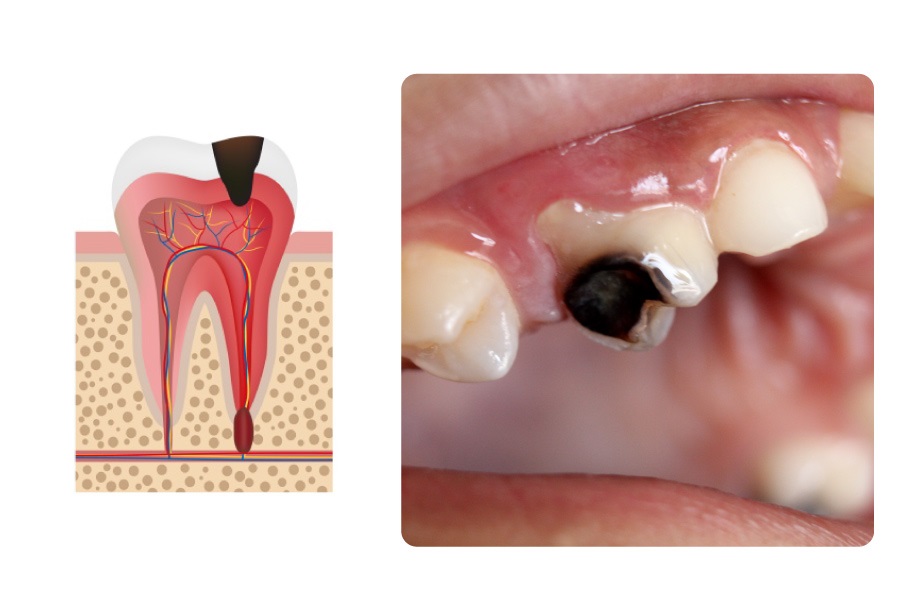 Biểu hiện của việc bị sâu răng
