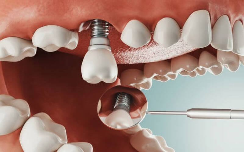 Phương pháp bọc răng sứ cho răng bị sâu
