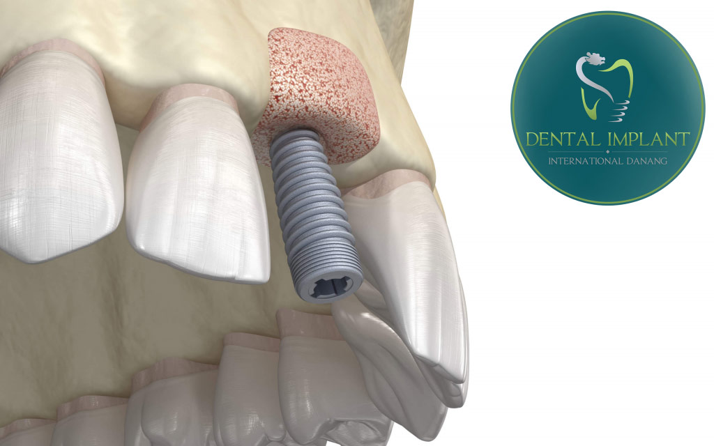 Ghép xương ổ răng là thủ thuật bổ sung thêm xương vào bên trong hàm răng