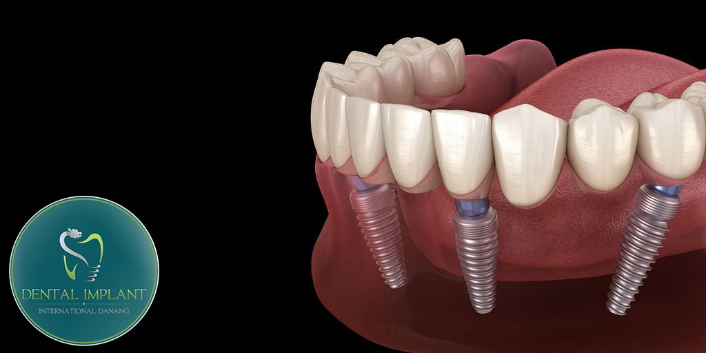 Các phương pháp duy trì tuổi thọ sau trồng răng implant all on 4