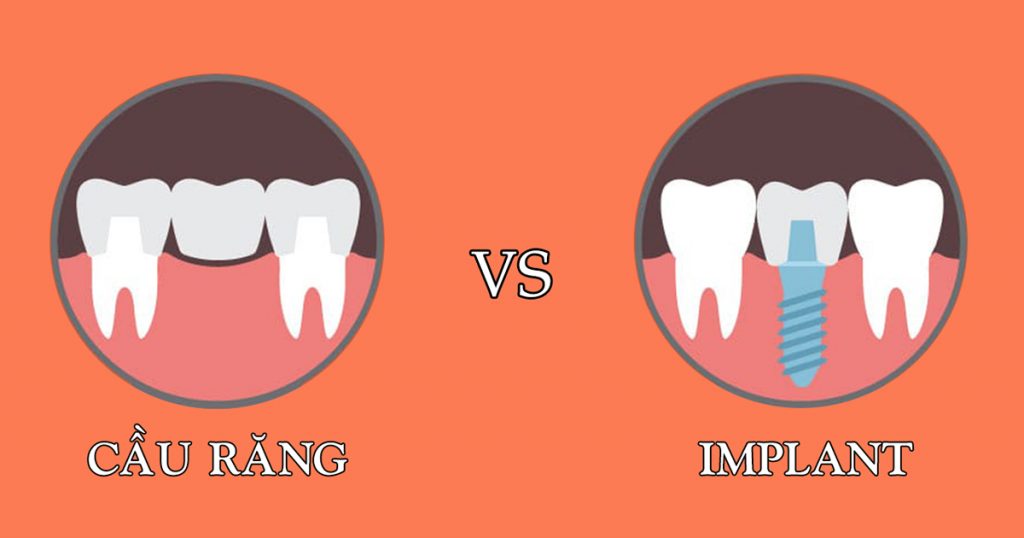 Cấy ghép răng Implant là cách khắc phục răng mất hiệu quả và nhanh chóng nhất hiện nay