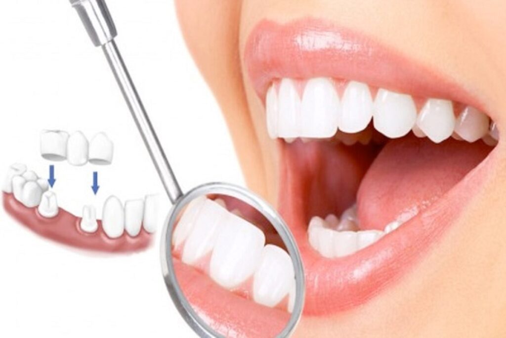 Trồng răng toàn sứ có những loại nào?