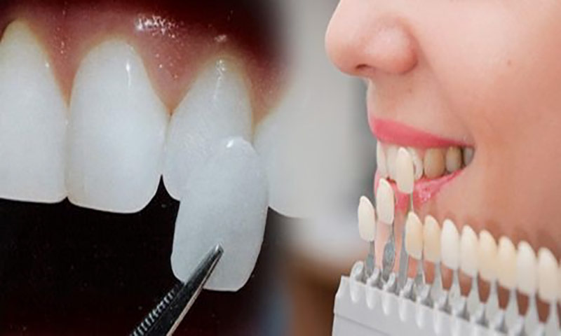 Dán răng sứ veneer có bền không? Có làm hỏng men răng không?