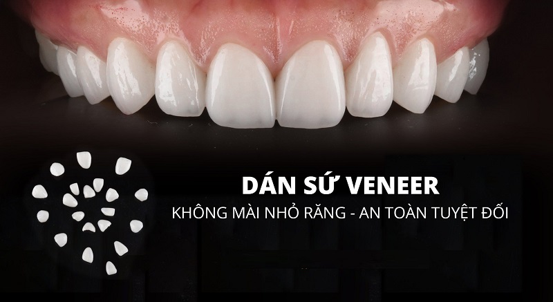 Răng sứ Veneer có ưu điểm nổi bật gì?