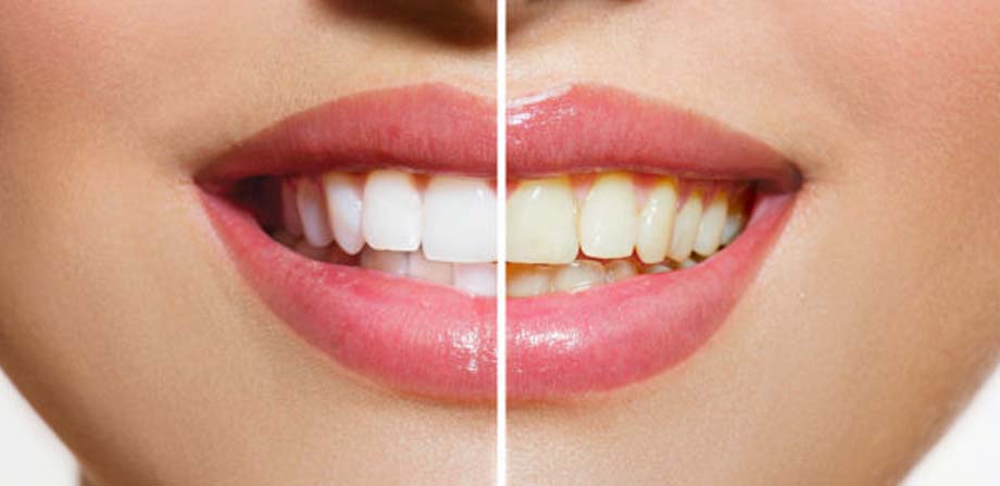 Nụ cười với hàm răng trắng sẽ giúp bạn trẻ trung và tự tin giao tiếp