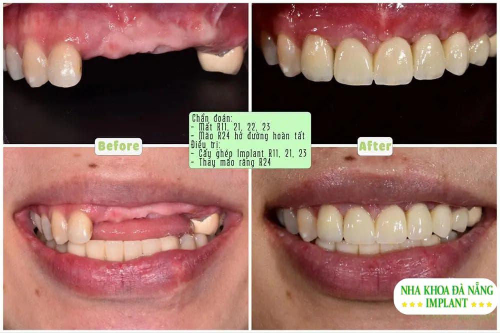 Trồng răng sứ là kỹ thuật nha khoa nhằm phục hình thẩm mỹ, phục hồi đủ số lượng răng