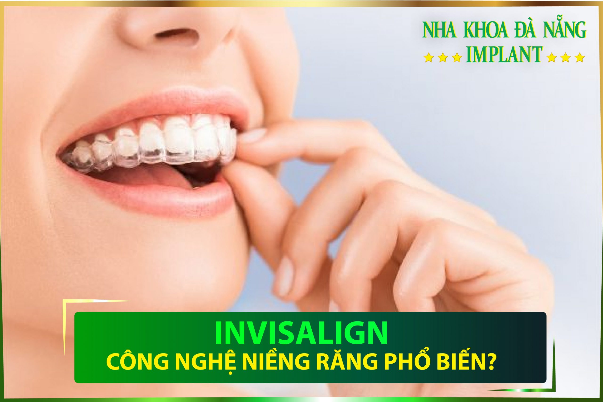 Niềng răng trong suốt Invisalign sử dụng các “khay” trong suốt mang lại thẩm mỹ tối đa