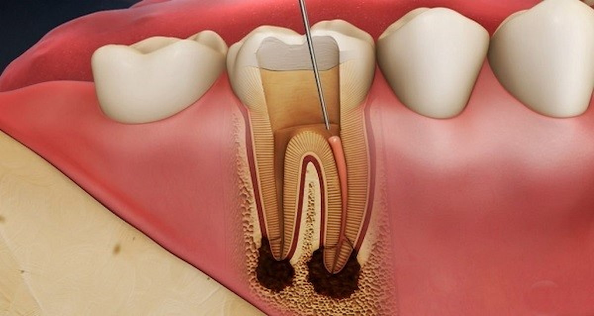 Nên cấy ghép implant hay điều trị tủy răng?