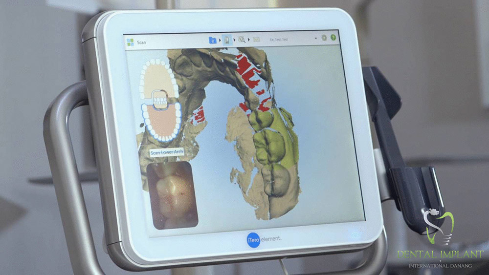 The iTero 3D Scanner scans and records the patient's jaw model on the computer